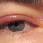 Blepharitis