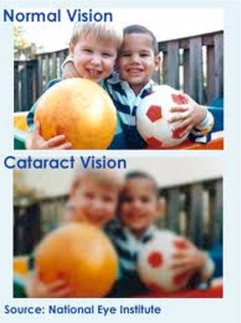 https://www.adelsoneyelaser.com/wp-content/uploads/2021/06/cataract-002.jpg