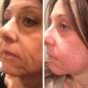 Facial Laser Resurfacing - before and after