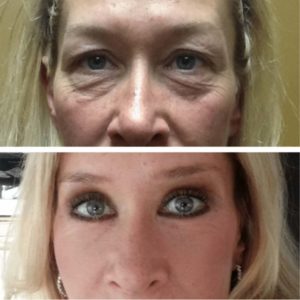 Facial Laser Resurfacing - before and after