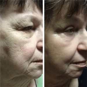 Facial Laser Resurfacing - before and after