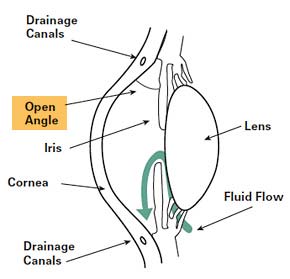 Open Angle Glaucoma diagram